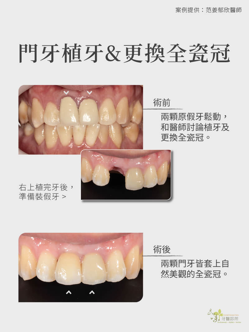 數位精準植牙 實際案例分享 導引式植牙 X Guide 藍光導航植牙 品味牙醫診所